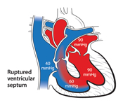 Ruptured ventricular septum